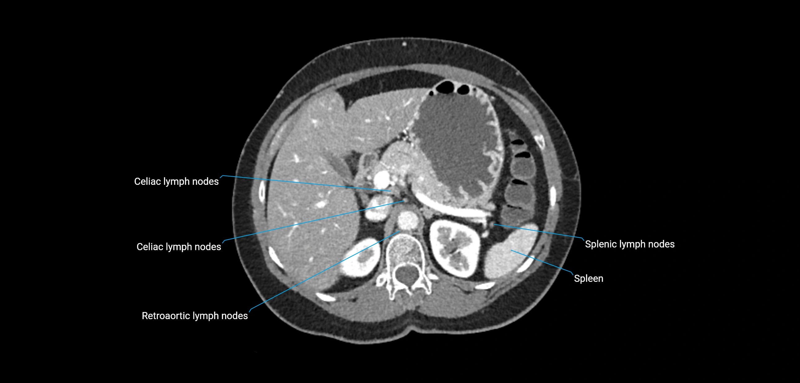 CT ct abdominal lymph nodes  axial cross sectional anatomy  enchanced radiology image -img-00002-00144.webp